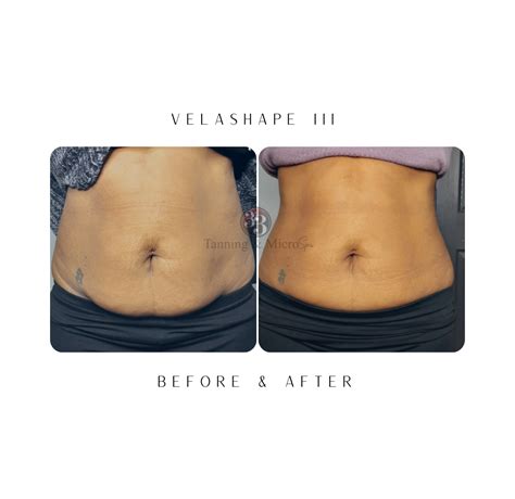 velashape reviews before and after.